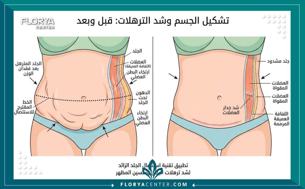 رسم توضيحي طبي يبين طبقات الجلد والعضلات قبل وبعد إجراء عملية شد الترهلات الجراحية.