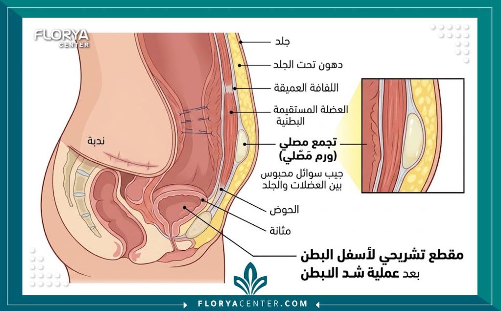 رسم توضيحي طبي يوضح السيروما ومكان تجمع السوائل تحت الجلد بعد عملية شد البطن.