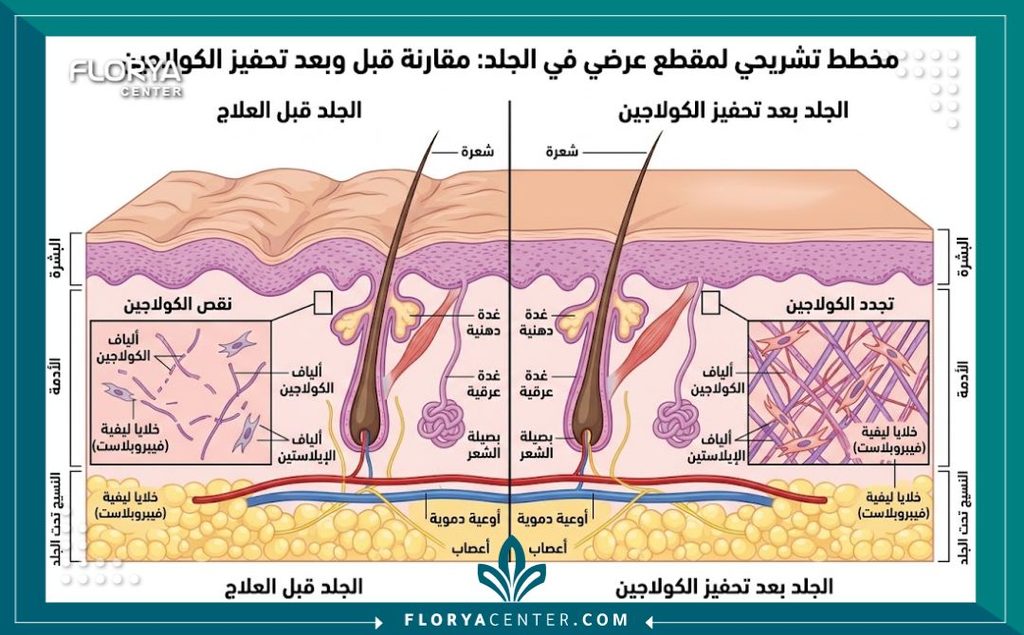 تحفيز الكولاجين للجسم 2 رسم توضيحي طبي لطبقات الجلد يشرح كيفية عمل إبر تحفيز الكولاجين للجسم وتجديد الألياف لشد الترهلات.