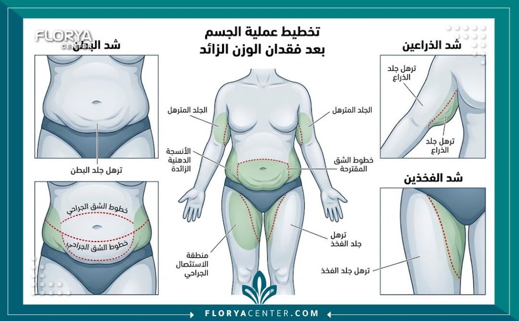 رسم توضيحي طبي يوضح أماكن ترهلات الجلد بعد التكميم في البطن والذراعين والفخذين مع خطوط القص الجراحي.