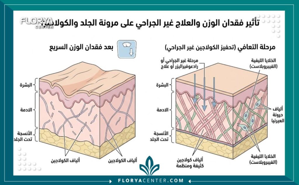 رسم توضيحي طبي لطبقات الجلد يشرح أسباب ترهل الجلد بعد النزول السريع للوزن بسبب حقن التخسيس وكيفية إعادة تحفيز الكولاجين.