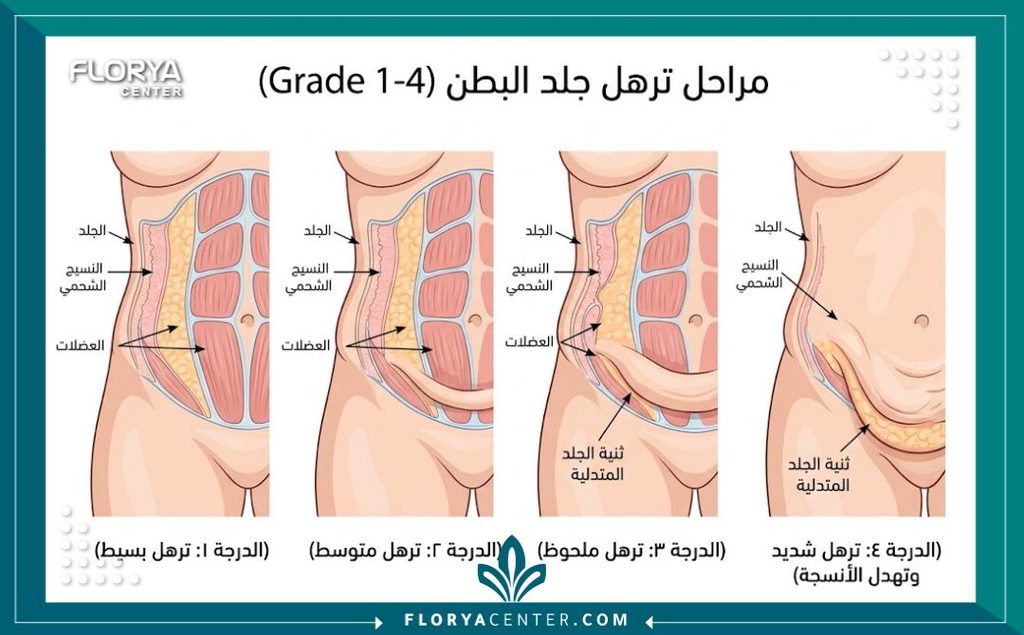 ترهلات الدرجة الرابعة 2 رسم توضيحي طبي يوضح درجات الترهل الجلدي مع التركيز على ترهلات الدرجة الرابعة التي تتطلب تدخلاً جراحياً لشد الجسم.
