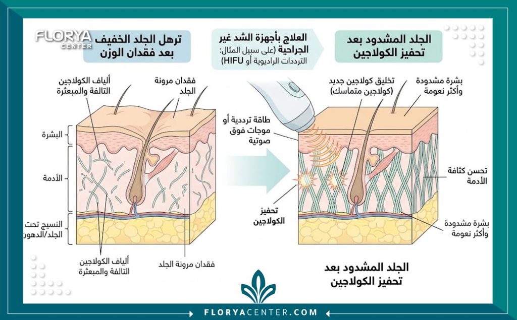 ترهلات الصيام المتقطع 2 رسم توضيحي لطبقات الجلد يوضح كيفية تحفيز الكولاجين لعلاج ترهلات الجلد بعد الصيام المتقطع.