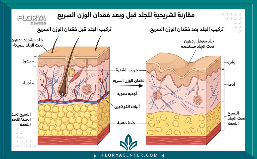 رسم توضيحي طبي لطبقات الجلد يوضح أسباب الترهل وفقدان المرونة بعد النزول السريع للوزن بإبر المنجارو.