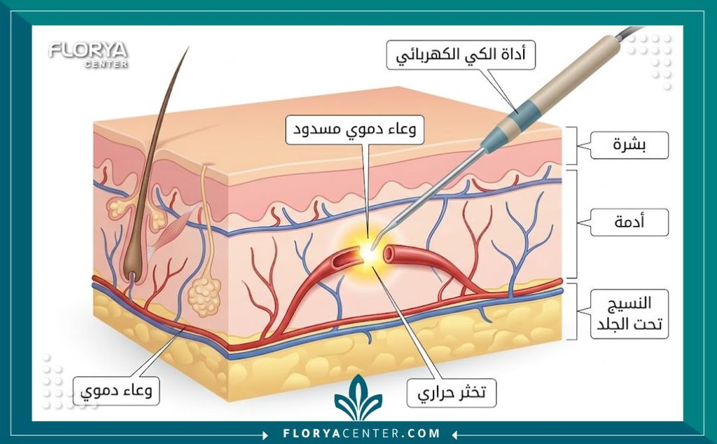 رسم توضيحي طبي يوضح آلية عمل تقنية الإرقاء الحراري في كي الأوعية الدموية ومنع النزيف أثناء الجراحة.
