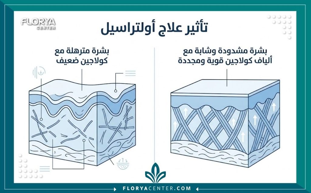 تقنية التراسييل لشد الجلد 3 إنفوجرافيك يوضح فوائد ومميزات تقنية التراسييل لشد الجلد وتأثيرها الفعال في تحفيز وإنتاج الكولاجين مقارنة بالبشرة المترهلة.