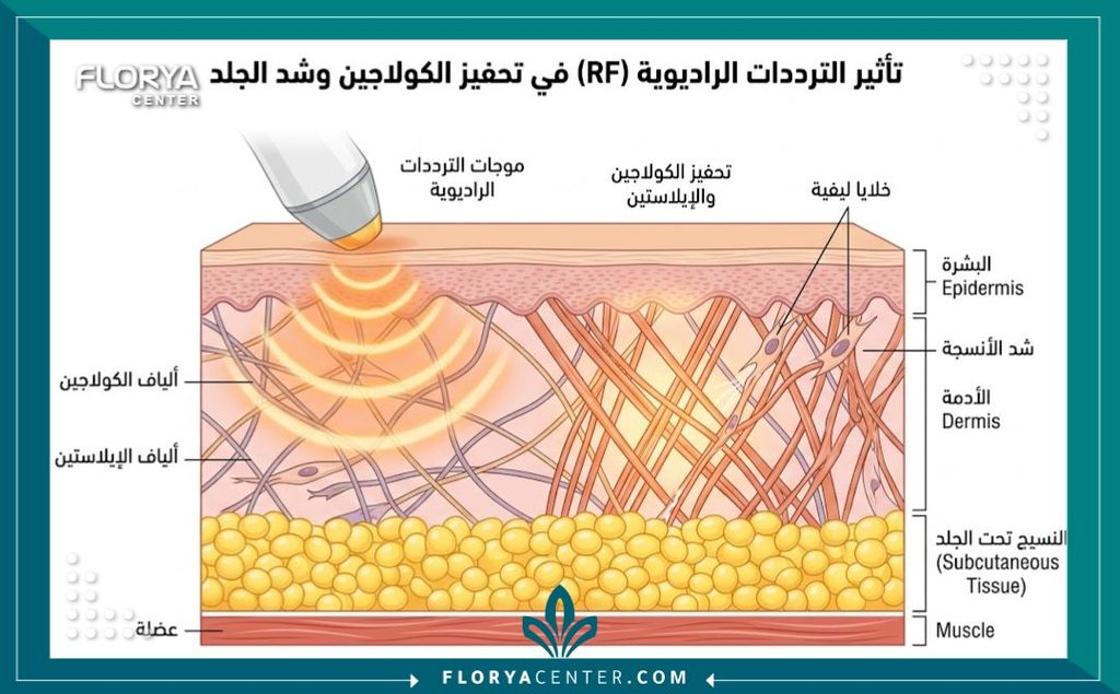 تقنية الثيرميفا (ThermiVa) للشد المتخصص 2 رسم طبي توضيحي يشرح كيف تعمل موجات الراديو فريكونسي في جهاز الثيرميفا على تحفيز الكولاجين وشد المناطق الحساسة.