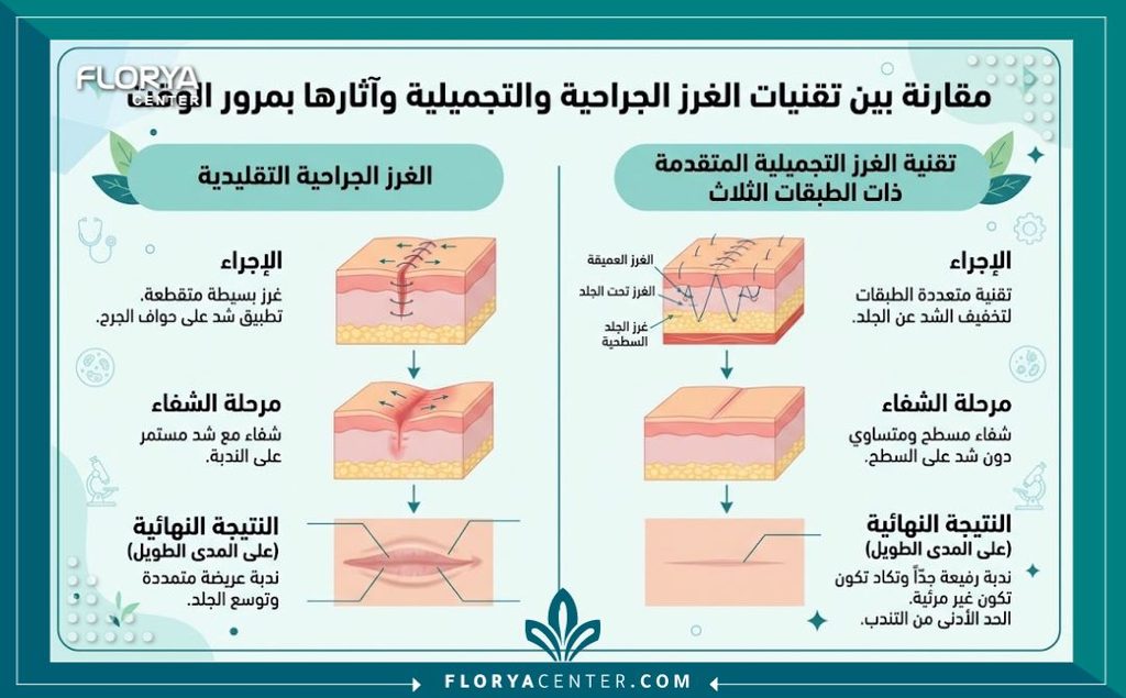 تقنية الخياطة التجميلية ثلاثية الطبقات 3 إنفوجرافيك يقارن بين الخياطة الجراحية العادية والخياطة التجميلية ثلاثية الطبقات مع مرور الوقت وكيفية الحفاظ على ندبة رقيقة جداً.