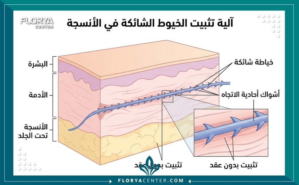 تقنية الخيوط الشائكة (Barbed Sutures) في شد الجروح 2 رسم توضيحي طبي يوضح تشريحياً آلية عمل الخيوط الشائكة وتثبيتها في الأنسجة بدون الحاجة لعقد.