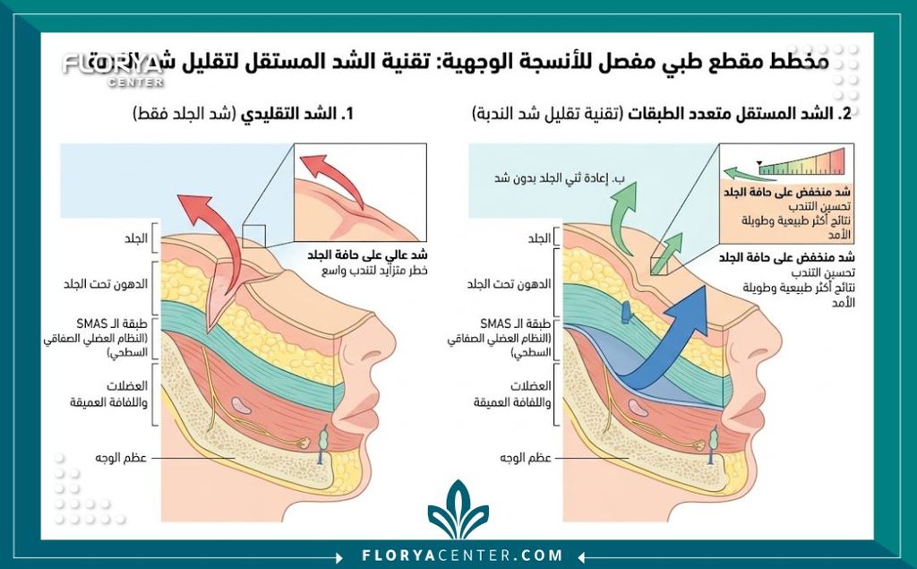 تقنية الرفع المزدوج للأنسجة الرخوة 2 رسم توضيحي طبي يشرح تشريح طبقات الجلد والدهون وكيفية توزيع الشد في تقنية الرفع المزدوج للأنسجة الرخوة.