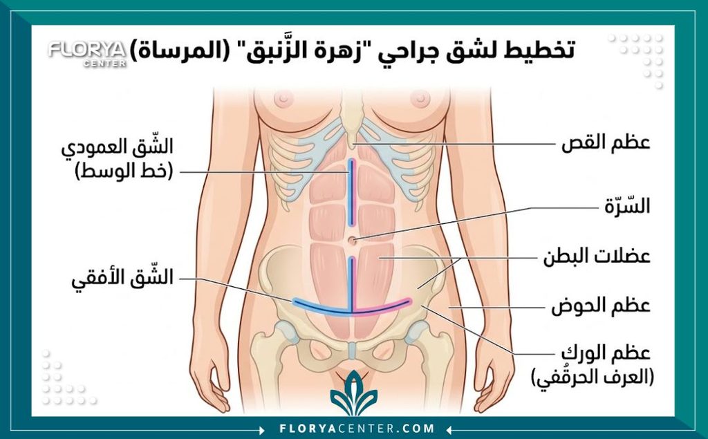 رسم توضيحي طبي يبين مسار تقنية الشق الجراحي على شكل مرساة والشد المقلوب في البطن.