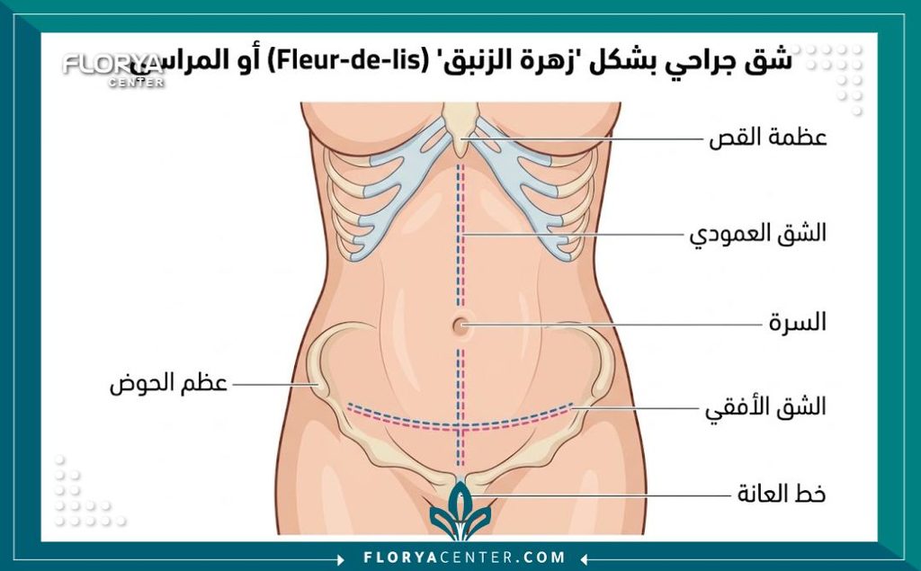 رسم توضيحي طبي يبين مسار تقنية الشق الجراحي على شكل مرساة والشد المقلوب في البطن.