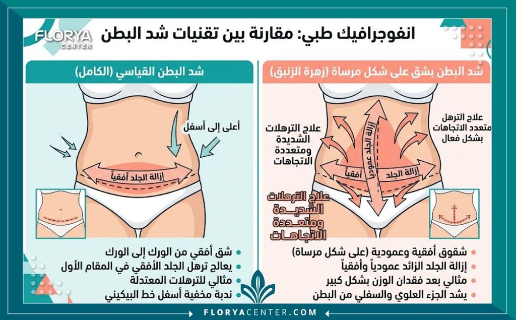 إنفوجرافيك يقارن بين الشد التقليدي والشد المقلوب لإزالة الترهل العرضي والطولي معاً.