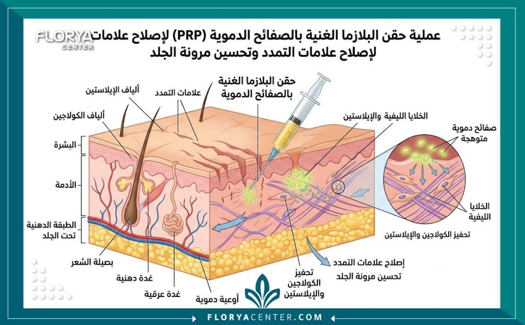 رسم توضيحي طبي ثلاثي الأبعاد يوضح كيف تعمل تقنية حقن البلازما (PRP) في طبقات الجلد لتحفيز الكولاجين وعلاج علامات التمدد.