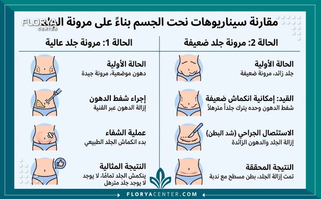 إنفوجرافيك يقارن بين نتائج شفط الدهون في حالات مرونة الجلد العالية مقابل الحاجة للقص الجراحي للترهلات.