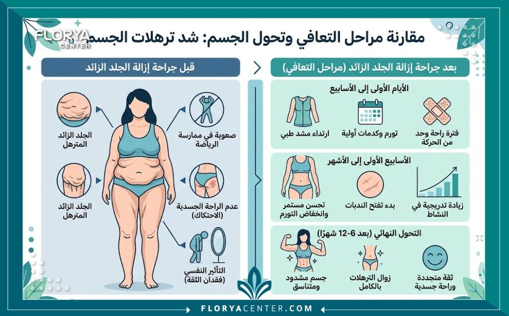 إنفوجرافيك طبي يوضح مراحل التعافي والفرق قبل وبعد عمليات شد الجسم والتخلص من الترهلات بعد إبر التنحيف.