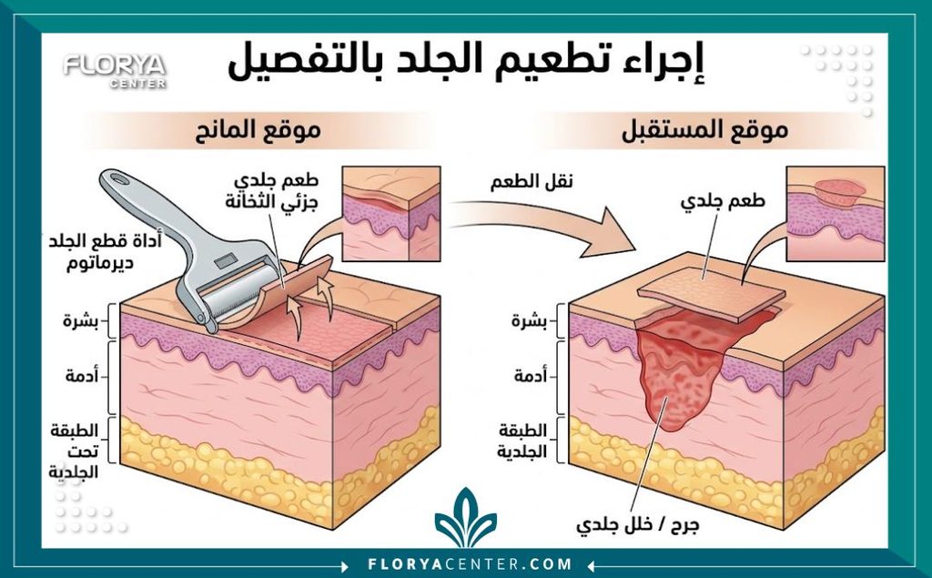 رسم طبي توضيحي يوضح طبقات الجلد وعملية نقل الطعوم أثناء جراحة الترقيع الجلدي للحالات المعقدة.
