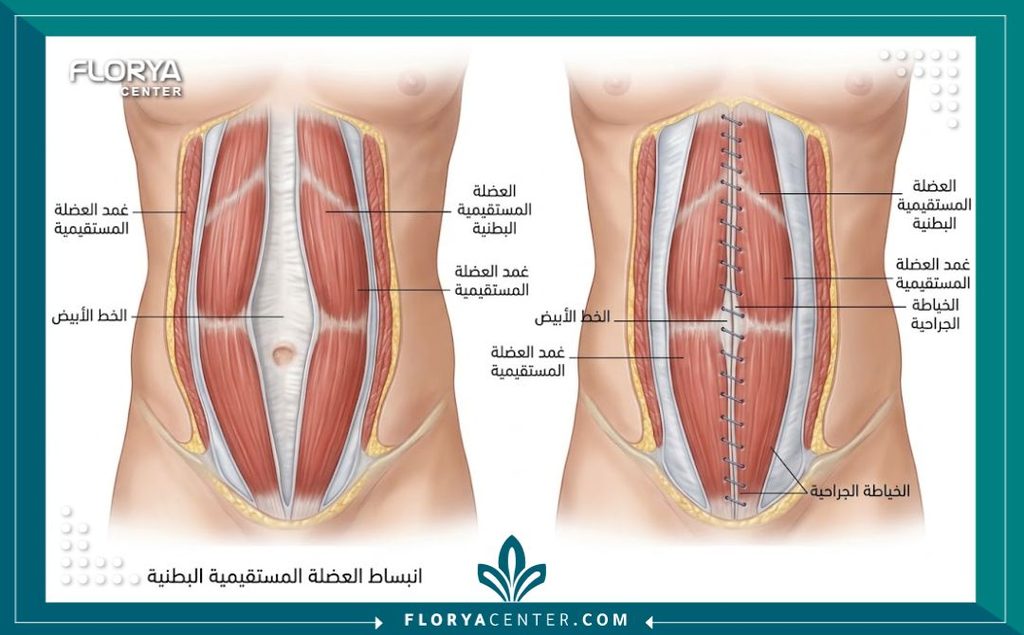 رسم توضيحي طبي دقيق يوضح التشريح الداخلي لجدار البطن قبل وبعد عملية خياطة العضلات المتباعدة.