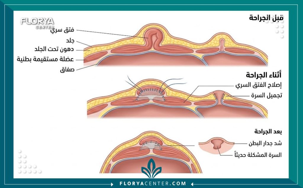 رسم توضيحي طبي لتشريح جدار البطن يوضح كيفية إجراء جراحة تجميل وتثبيت السرة وإصلاح الفتق السري.