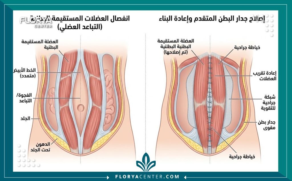 رسم توضيحي طبي لتشريح عضلات البطن يوضح الفرق قبل وبعد عملية ترميم الجدار البطني المتقدم وعلاج الانفصال العضلي.