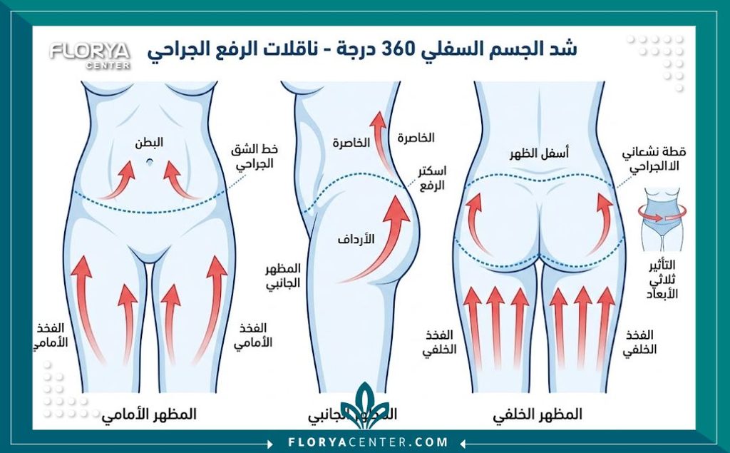 رسم توضيحي طبي يشرح مناطق الشد 360 درجة في عملية شد الجزء السفلي من الجسم بما في ذلك البطن والأرداف والأفخاذ.