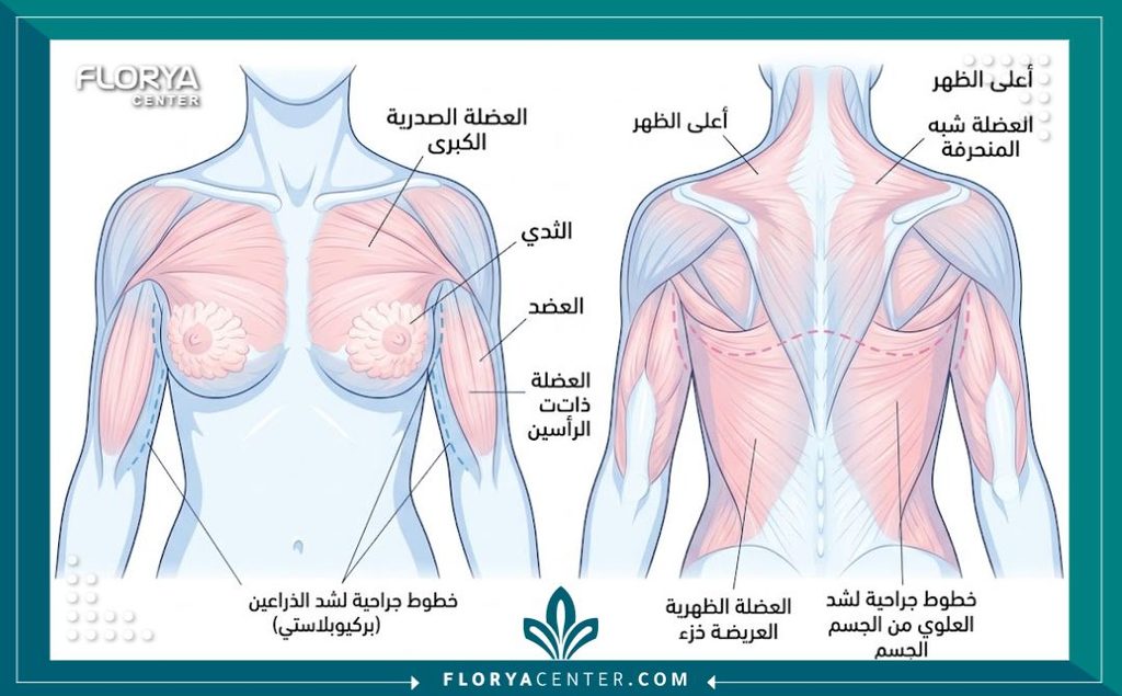 جراحة شد الأطراف العلوية (Upper Body Lift) 2 رسم توضيحي طبي يبين مناطق التدخل الجراحي في عملية شد الأطراف العلوية، بما في ذلك الذراعين والظهر العلوي ورفع الثدي.