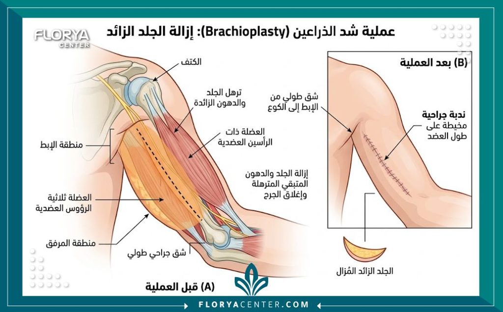 رسم توضيحي طبي يشرح تشريح منطقة الذراع ومكان قص الترهلات الطولية من الإبط إلى الكوع في عملية شد الذراعين.