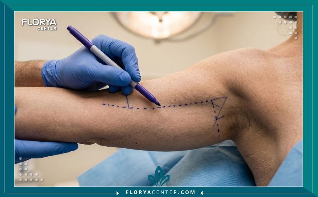 طبيب التجميل يقوم بتخطيط وتحديد مناطق الجلد الزائد على الذراع استعداداً لعملية قص الترهلات الطولية.