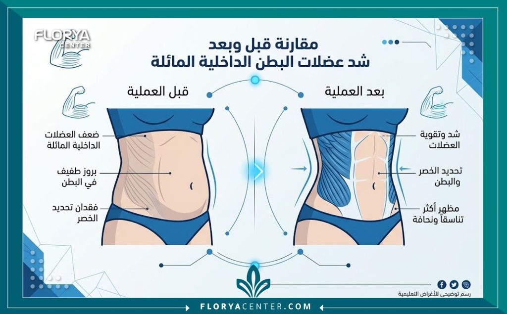إنفوجرافيك يوضح مراحل وفوائد عملية نحت الخصر والفرق قبل وبعد جراحة شد العضلات المائلة الداخلية.