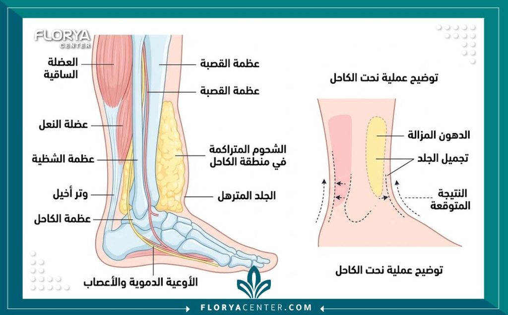 رسم توضيحي طبي يشرح تشريح منطقة أسفل الساق ويوضح أماكن تجمع الدهون والجلد الزائد المستهدفة في جراحة شد الكاحل.