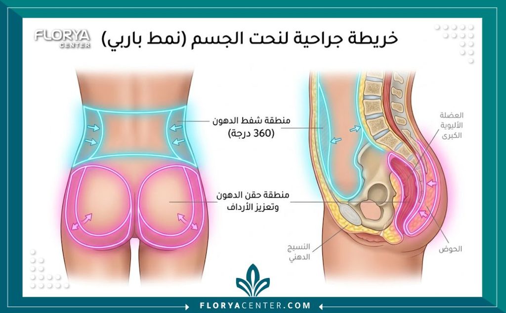 جراحة نحت القوام "الباربي" 2 رسم توضيحي طبي لمناطق شفط الدهون وحقن الدهون الذاتية في عملية نحت القوام الباربي.