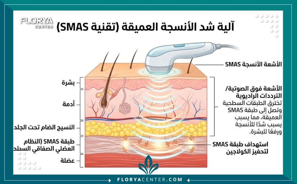 رسم توضيحي طبي لطبقات الجلد يوضح كيفية اختراق تقنيات جهاز ألتراسل لشد الطبقات العميقة وطبقة SMAS بدون جراحة.