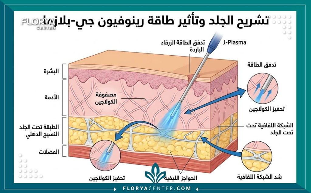 رسم توضيحي طبي لآلية عمل جهاز رينوفيون جي بلازما لشد اللفافة العضلية وتحفيز الكولاجين تحت الجلد.