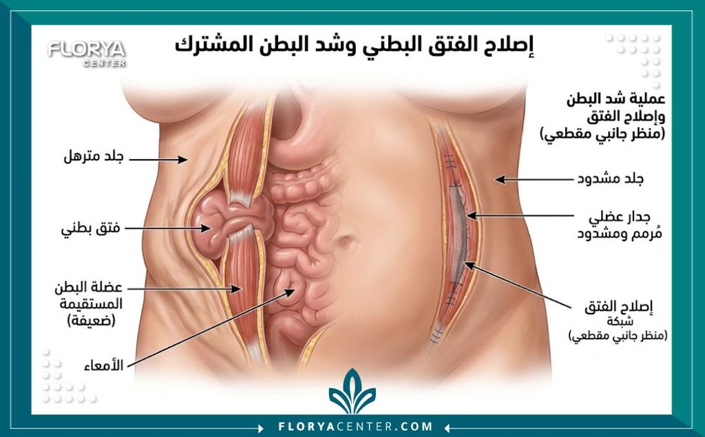 رسم توضيحي طبي يشرح تشريح جدار البطن قبل وبعد عملية إصلاح الفتق السري أو الإربي المدمجة مع شد البطن.