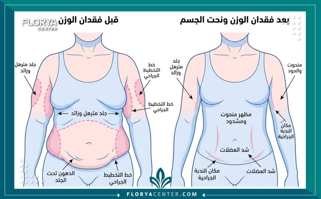 رسم توضيحي طبي يوضح أماكن استئصال الترهلات ضمن إجراءات عملية قص الجلد وشد الجسم.