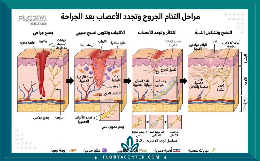 رسم توضيحي طبي لطبقات الجلد يفسر التئام الأعصاب كسبب رئيسي لظهور حكة جرح عملية الشد.