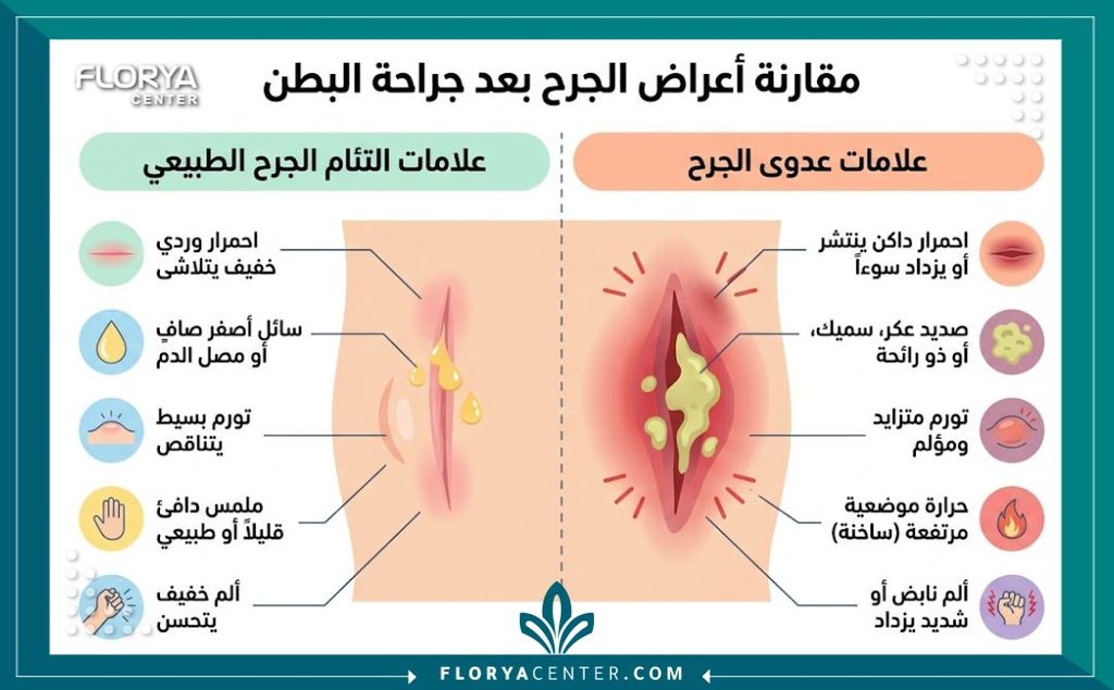 خروج سائل أصفر من جرح شد البطن 3 إنفوجرافيك يقارن بين السائل الأصفر الطبيعي (المصل) وعلامات الصديد والالتهاب في جرح شد البطن.