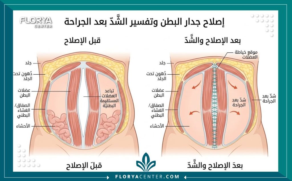 رسم توضيحي طبي لطبقات البطن يشرح سبب ألم شد العضلات بعد عملية شد الترهلات وكيفية ترميم الجدار العضلي.