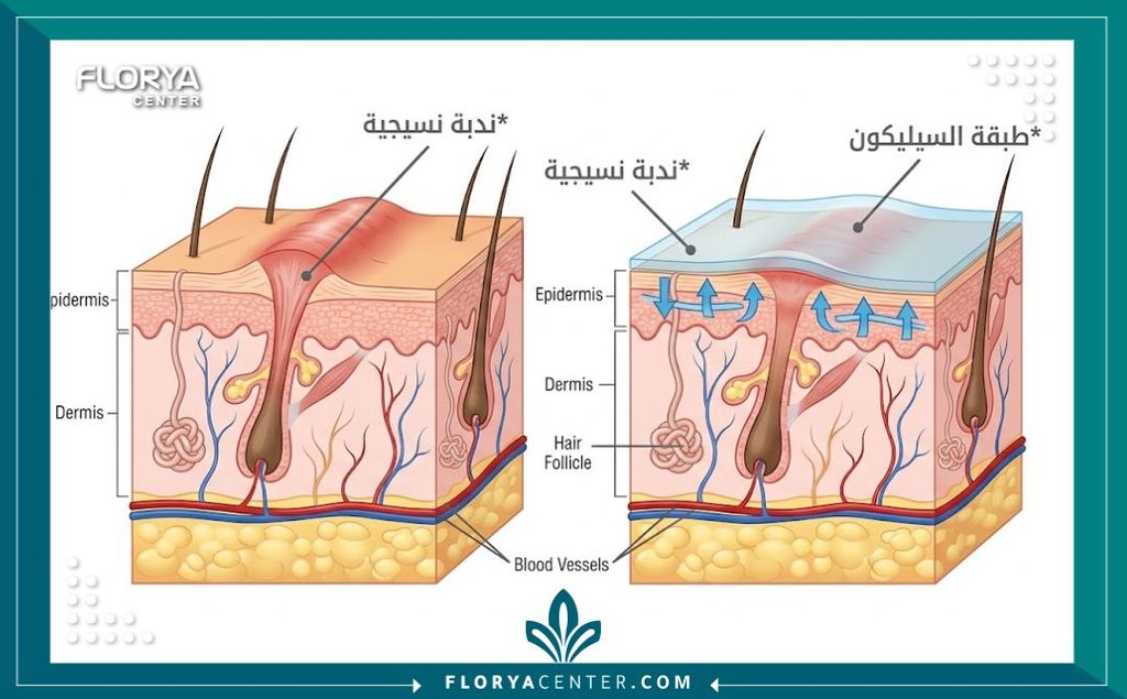 رسم توضيحي طبي يوضح كيف يعالج سيليكون جروح العمليات الندبات البارزة ويحسن مظهرها.