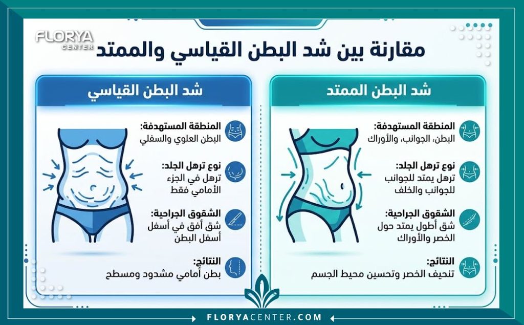 شد البطن الممتد 3 إنفوجرافيك يقارن بين عملية شد البطن العادي وشد البطن الممتد للحالات التي تعاني من ترهل الخصر.