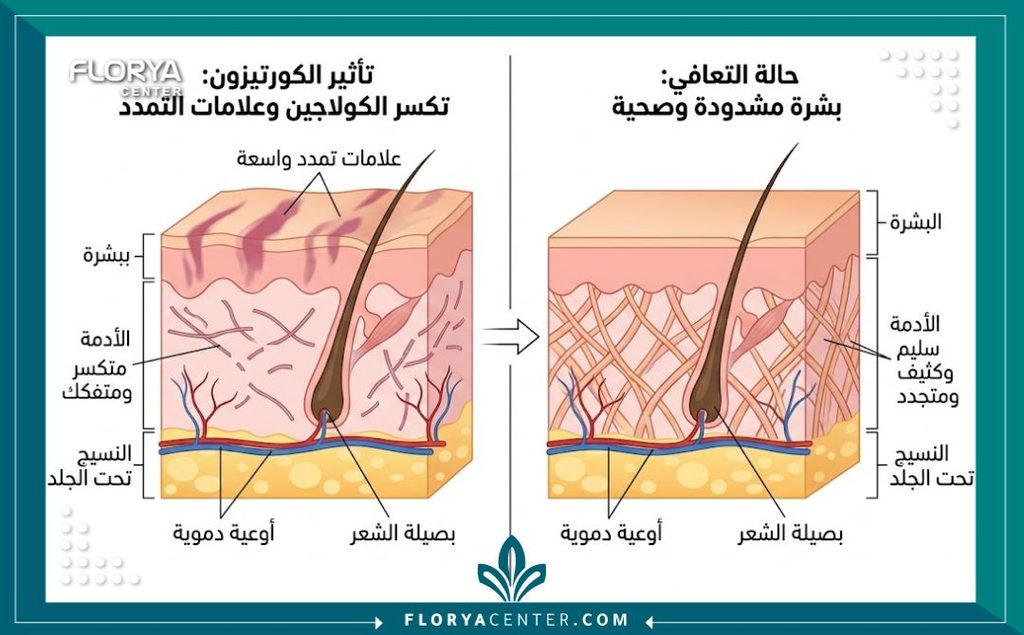 شد الترهلات الناتجة عن الكورتيزون 2 رسم توضيحي طبي لطبقات الجلد يوضح تأثير الكورتيزون والخلل الطبي وكيفية علاج التشققات الجلدية العريضة.
