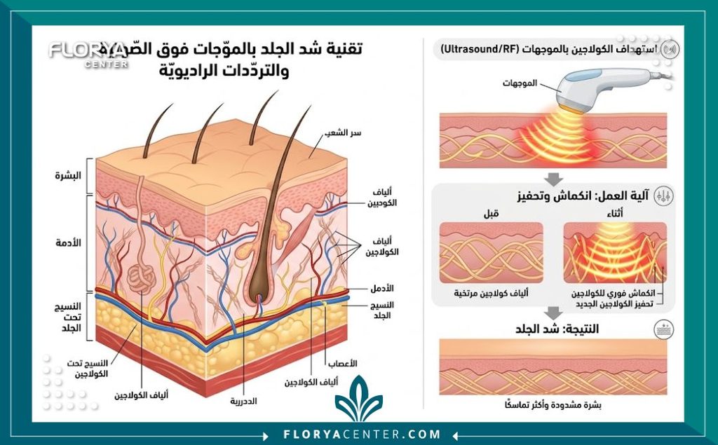 رسم توضيحي لطبقات الجلد يوضح كيفية تحفيز الكولاجين وعلاج الترهلات العميقة باستخدام تقنية الهايفو بدون جراحة.