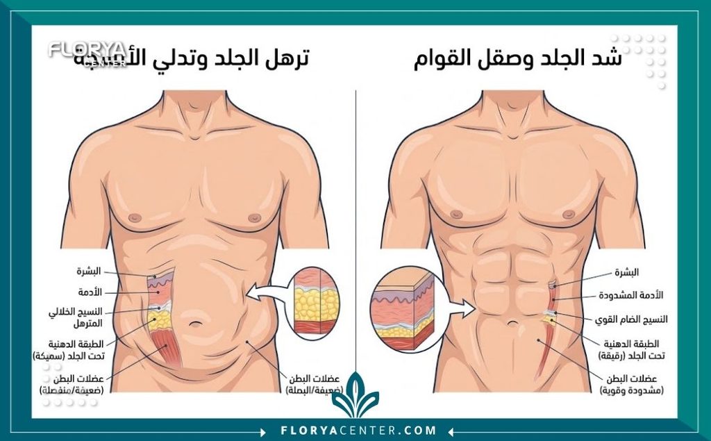 رسم توضيحي طبي يبين الفرق بين طبقات الجلد قبل وبعد عملية شد ترهلات الصدر والبطن للرجال.