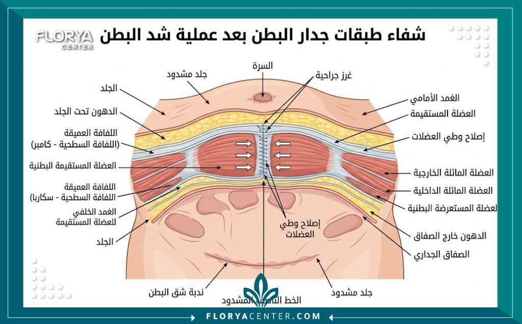 رسم طبي توضيحي يوضح شد عضلات البطن والتئام الأنسجة الداخلي بعد الجراحة.