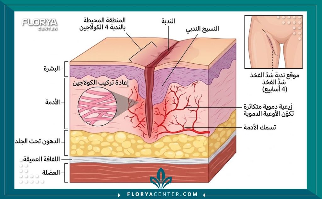 شكل الجرح بعد شهر من عملية شد الأفخاذ 2 رسم توضيحي طبي لطبقات الجلد يوضح أسباب احمرار وسماكة شكل الجرح بعد شهر من عملية شد الأفخاذ بسبب نشاط الكولاجين.