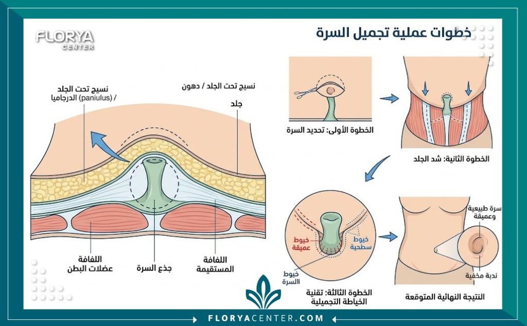 رسم توضيحي طبي يشرح تشريحياً كيفية نحت شكل السرة الجديد أثناء عملية شد البطن للحصول على مظهر طبيعي.