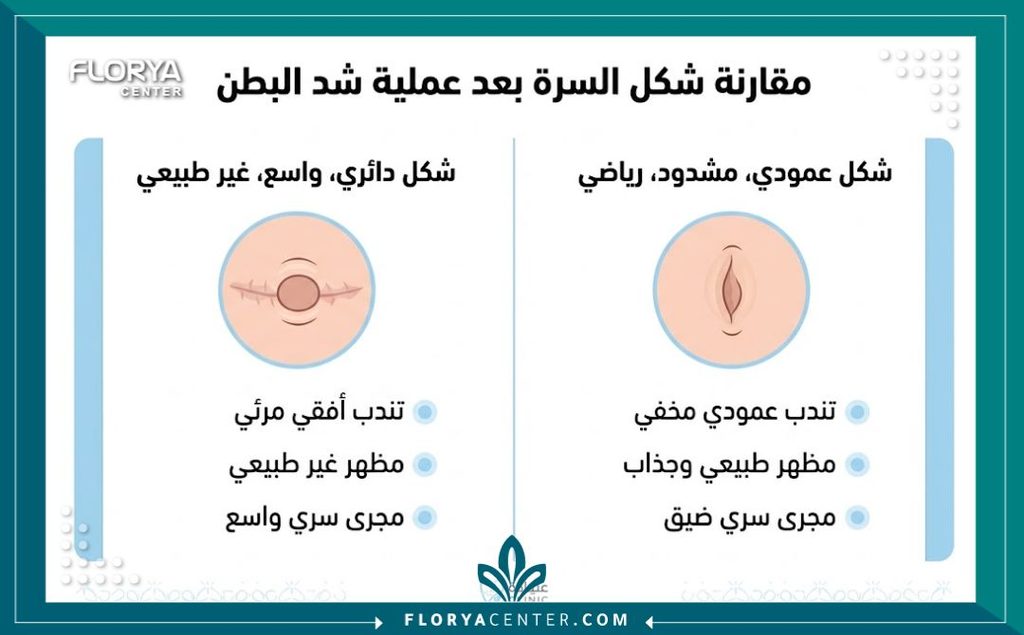 إنفوجرافيك يقارن بين شكل السرة المشوه الواسع وشكل السرة الرياضي الطبيعي بعد شد البطن لتقييم النتائج.