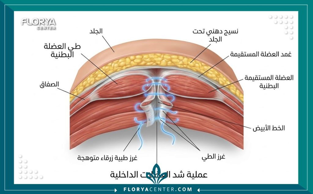 رسم توضيحي طبي دقيق يوضح شكل غرز شد البطن من الداخل وكيفية طي العضلة (Plication) للحصول على خصر منحوت.