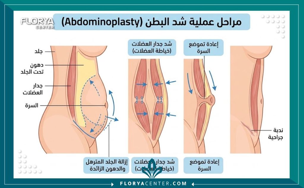 رسم توضيحي طبي يشرح خطوات عملية شد البطن، وتقوية العضلات، وتكنيك تجميل السرة الجراحي.
