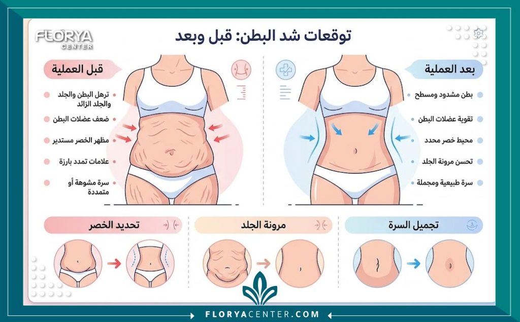 إنفوجرافيك يقارن شكل الجسم قبل وبعد شد البطن، يوضح تفاصيل نحت الخصر وتجميل السرة وشد الترهلات.